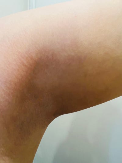 분당 부유방 병원 직원도 부유방 수술을 맡기는 병원 사진 3