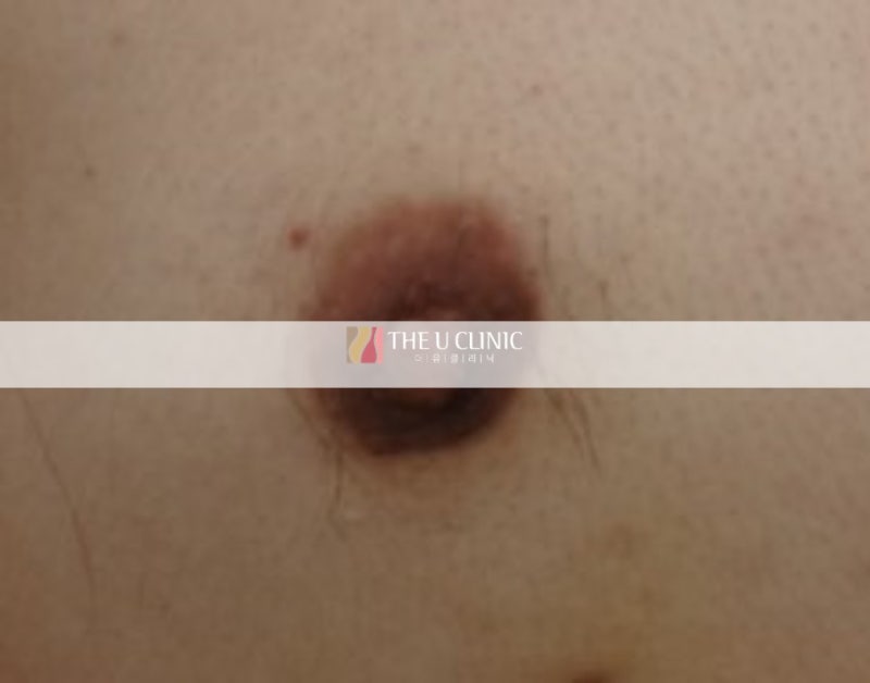 여유증 수술 흉터? 수술 후 환자의 실제 반응을 알려드립니다 사진 3