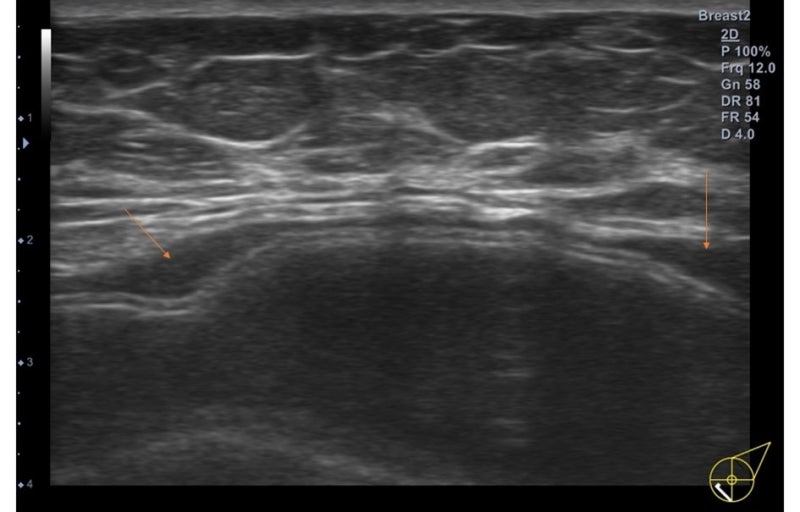 보형물 제거. 프랑스 PIP사의 보형물