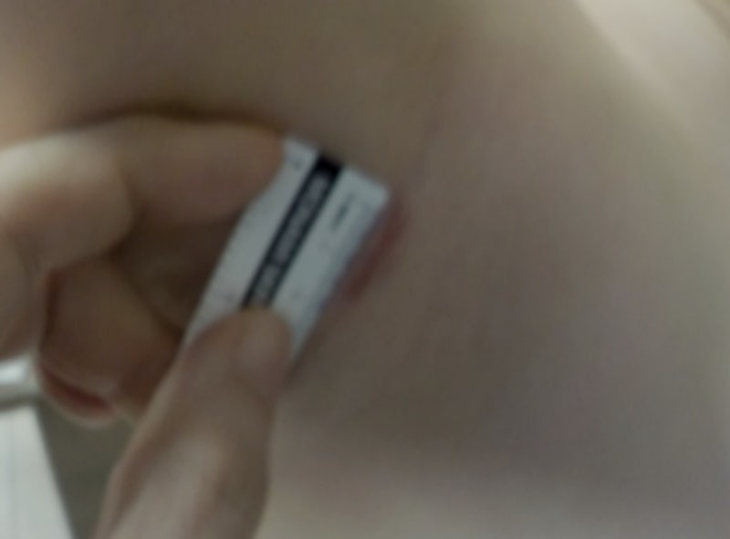 최소절개 부유방 수술이란? 2편