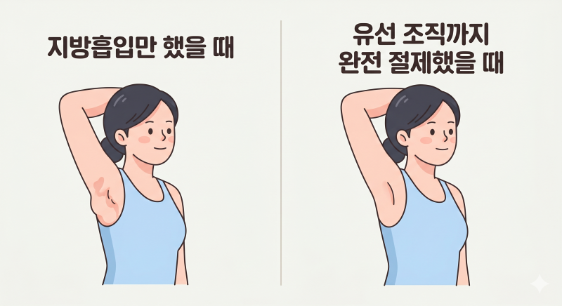 겨드랑이 볼록살, 단순 다이어트로 안 빠진다면? 최소절개 부유방 수술 전 가장 많이 묻는 3가지