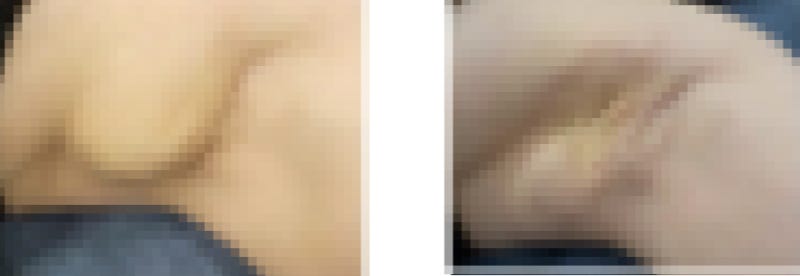 부유방 수술 후 '장액종', 왜 발생하고 언제까지 지속될까? 사진 2