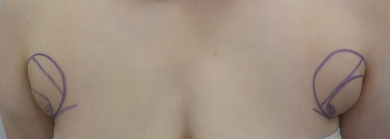 [부유방 수술]회복에 집중하는 하루 여정, 입원부터 퇴원까지 어떻게 진행되나? 사진 2