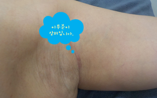 "최소절개라더니 수술 후에 말이 바뀌네요" 부유방 수술 전 반드시 알아야 할 진실